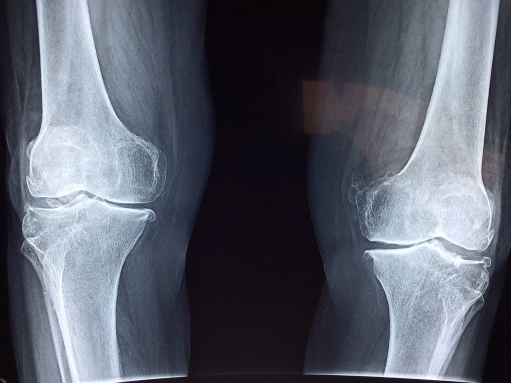 Röntgenbild der Knie (beide Beine), denn die Knie gehören zu Saturn